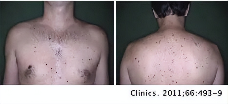 痣变黑变大是癌变了还是癌前病变,背上长了个肉痣是癌的象征吗