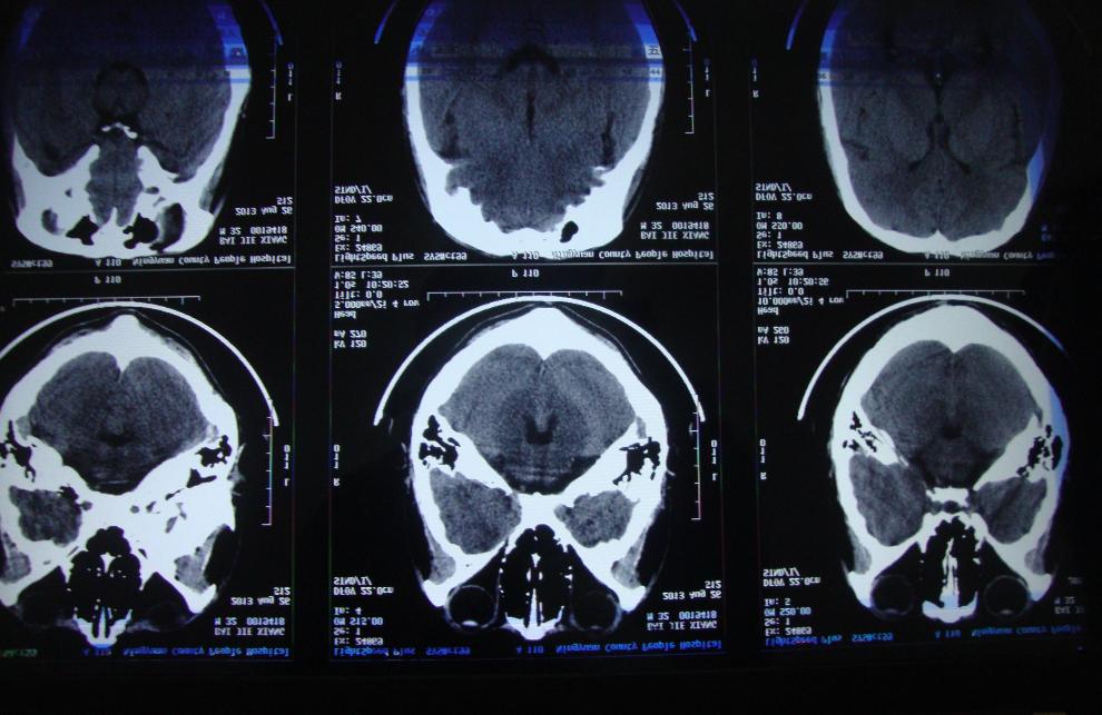 哪种药用来治脑萎缩,担心脑萎缩如何延缓脑的衰老