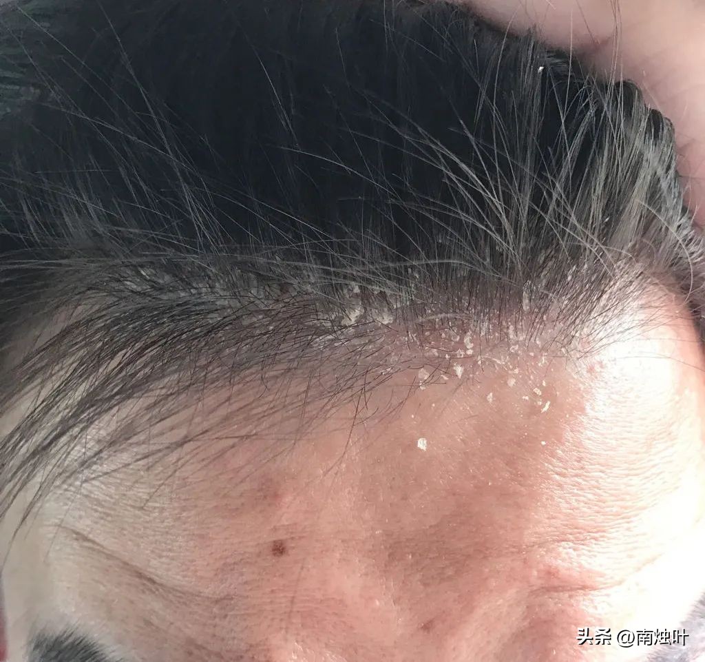 洗发水为什么越洗越多头屑,为什么用海飞丝洗头头屑越洗越多