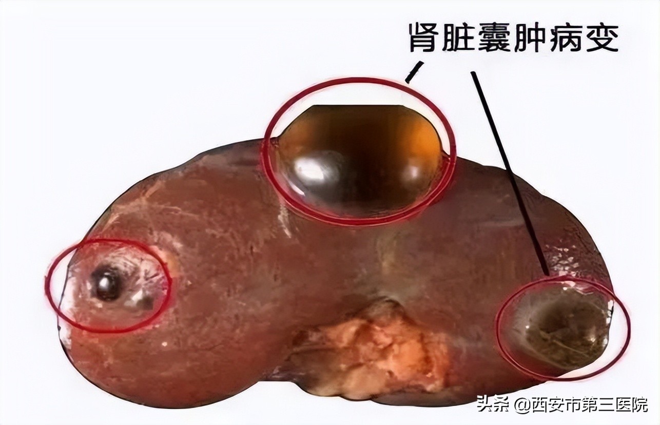 肾囊肿跟肿瘤有什么区别,囊肿在检查过程中破了会怎样