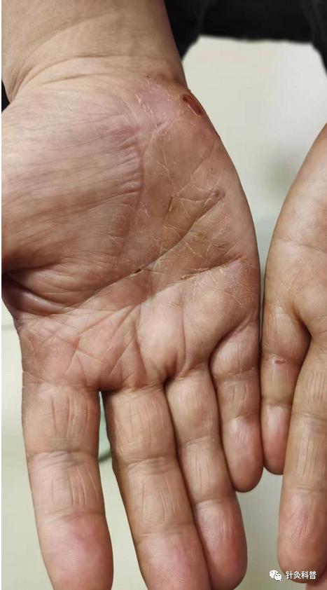 皮肤湿疹可以针灸治疗吗,针灸治疗脸上湿疹的绝招