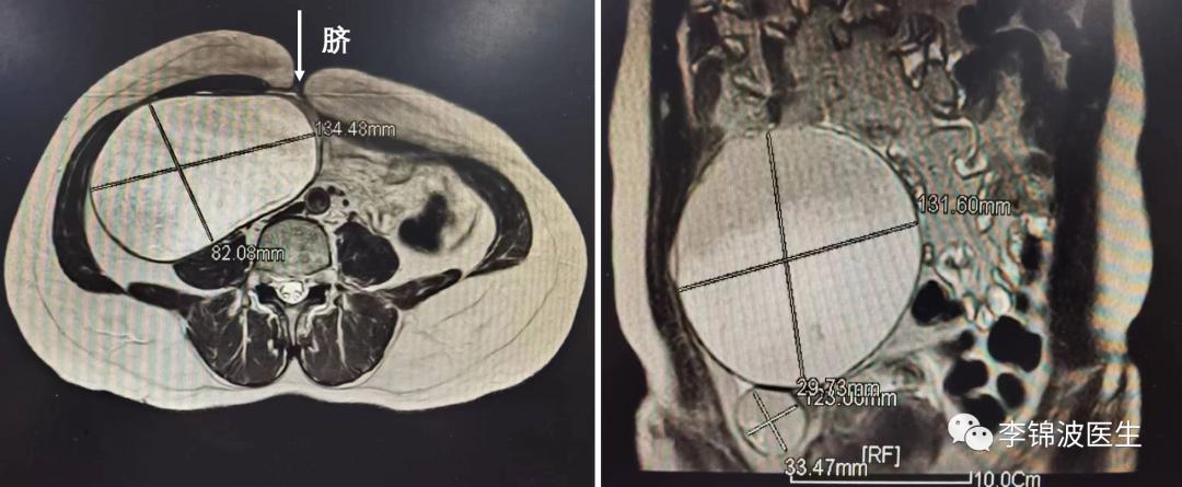 卵巢囊肿超过8cm还能微创手术么,卵巢囊肿大怎样动手术