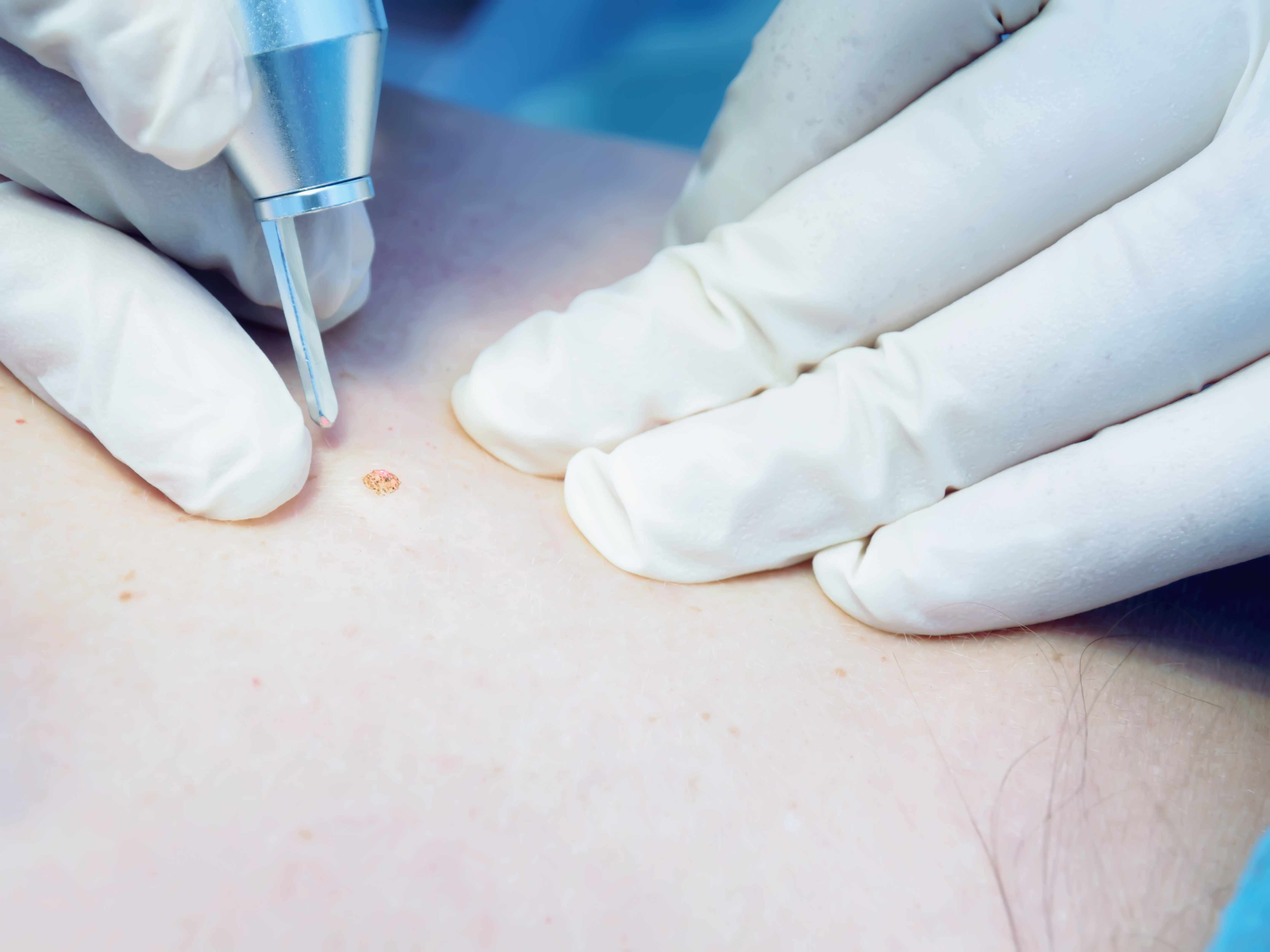 血管瘤和血管痣如何鉴别,血痣是血管瘤引起的吗