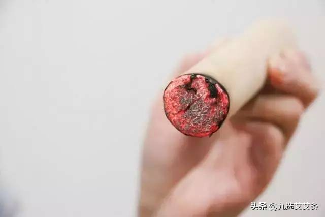 子宫腺肌症艾灸哪个穴位最好,做艾灸能改善子宫动脉阻力么