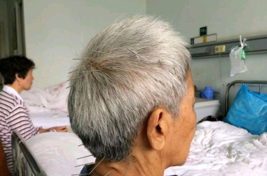 焦顺发针灸视频教程,焦氏头针疗法针灸视频