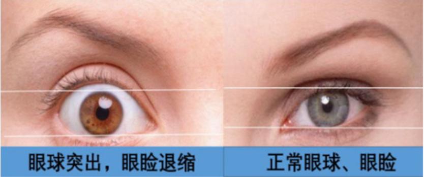 长期睁着眼睛睡觉，对身体有害会致盲？医生建议需牢记