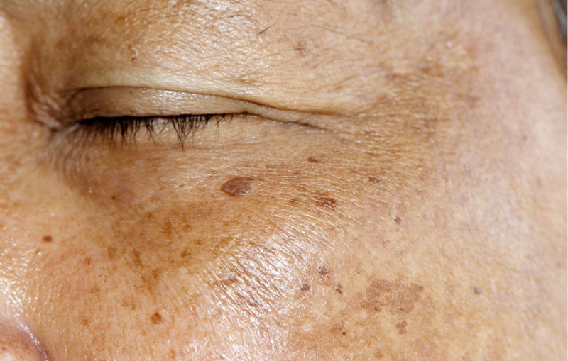 面部斑点小常识大全,面部斑点怎么消除中医