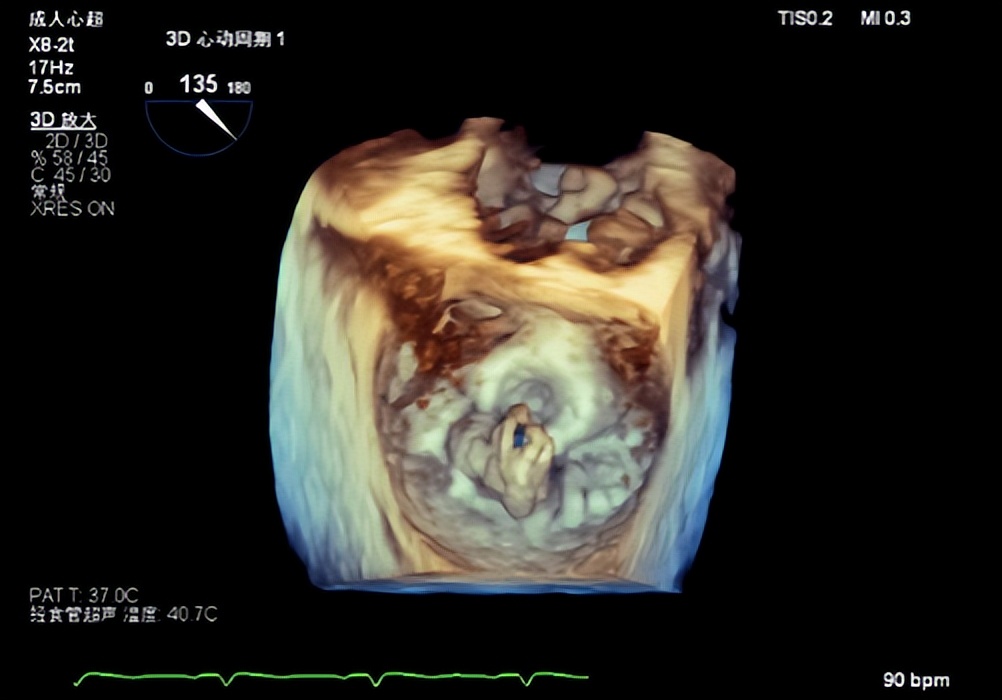 郑州大学第一附属医院心脏瓣膜,新技术治疗心脏瓣膜病