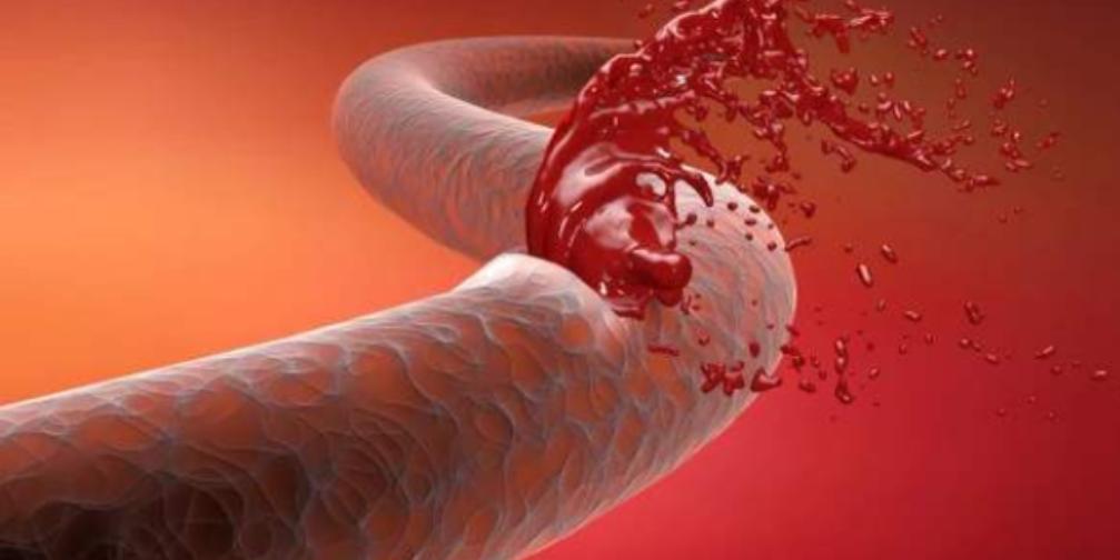 血管堵不堵劝你及时做好4件事,血管不好血难抽如何改善血管