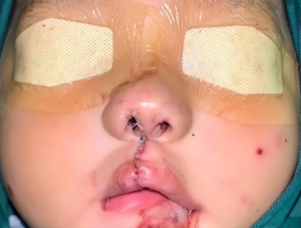 婴儿唇腭裂怎么护理,唇腭裂麻醉