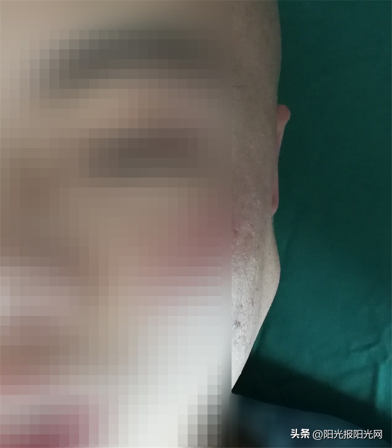 左侧腮腺肿瘤恶化,颈部腮腺疯狂长肿瘤