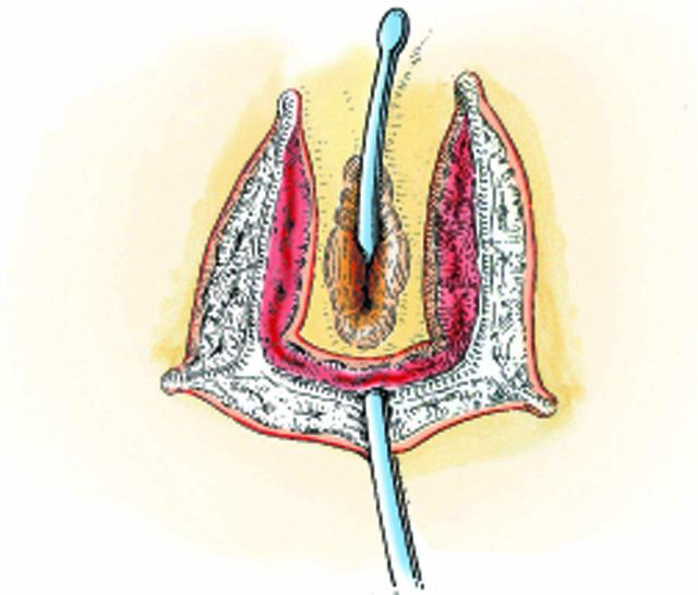 十大最痛的手术,公认最疼的三个手术