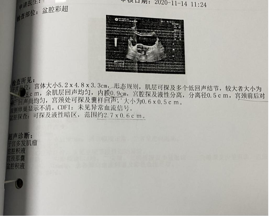 子宫多发肌瘤、宫腔积液、宫颈那囊、盆腔积液，这是什么病？