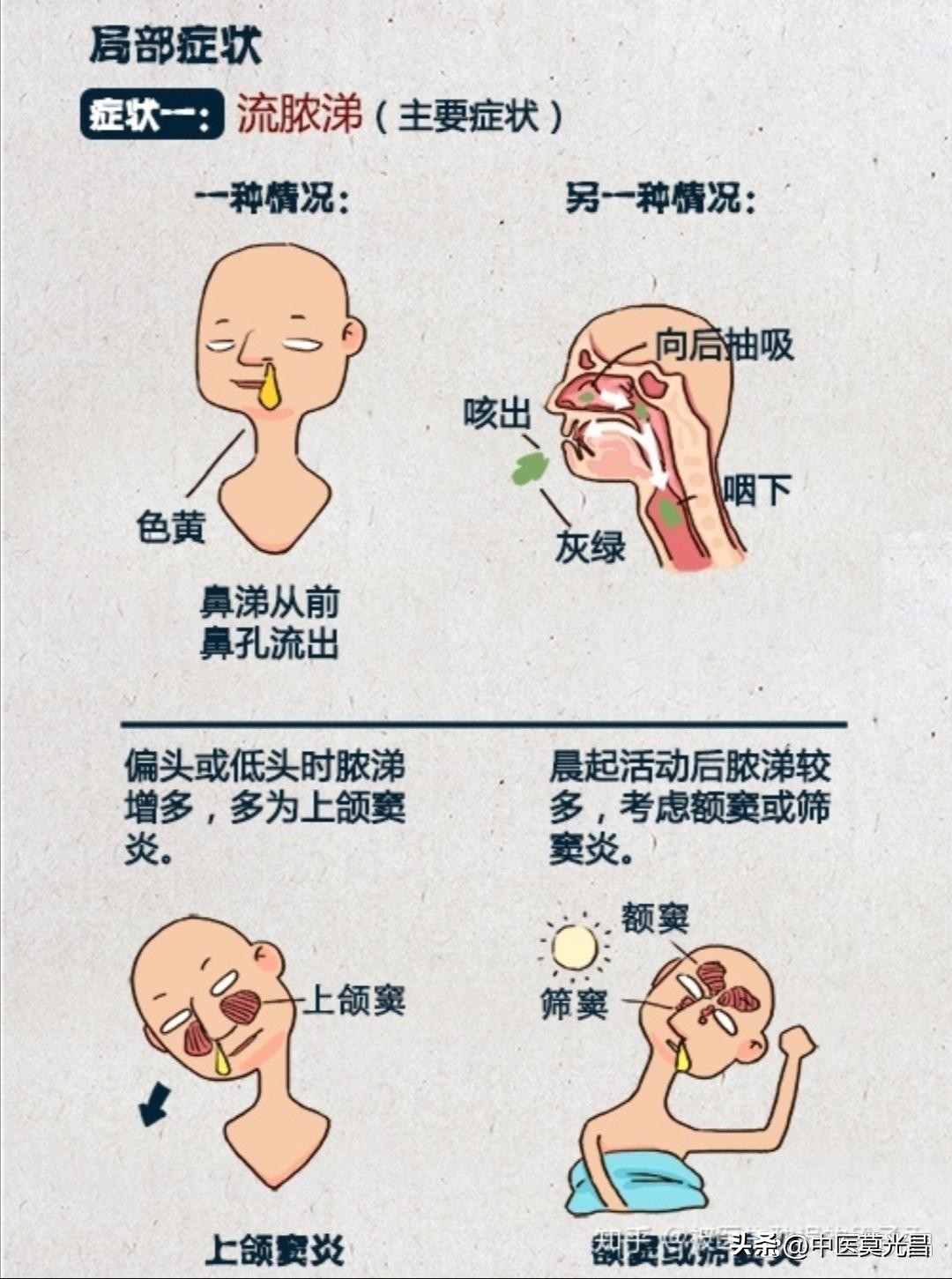 介绍一下西医关于鼻炎的治疗方案,慢性鼻炎怎么用中医治好