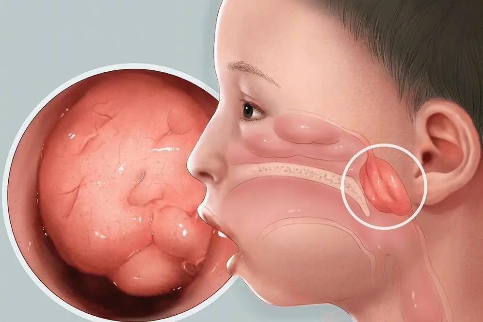 5岁小儿治疗腺样体肥大效果好吗,10岁腺样体扁桃体肥大吃什么中药
