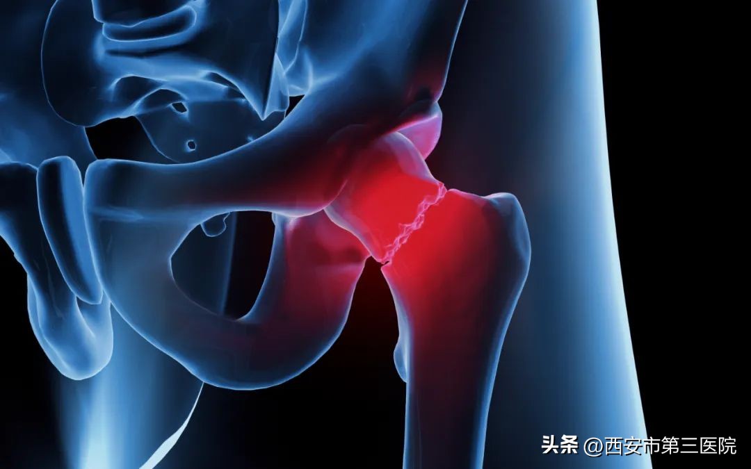 患者福音｜巩固一生，赢战骨折