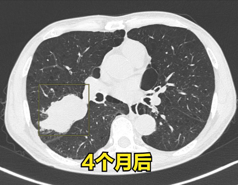肺癌穿刺活检会使癌症发展得快吗,肺癌穿刺活检的风险