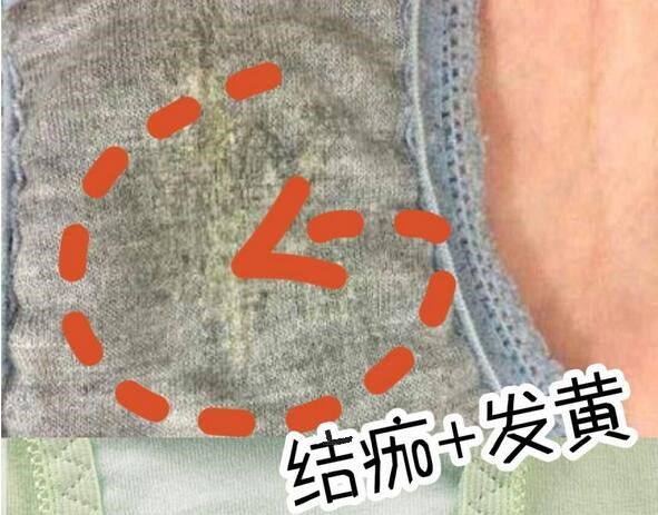 混合型妇科病瘙痒有豆腐渣怎么治,女人妇科病瘙痒有豆腐渣