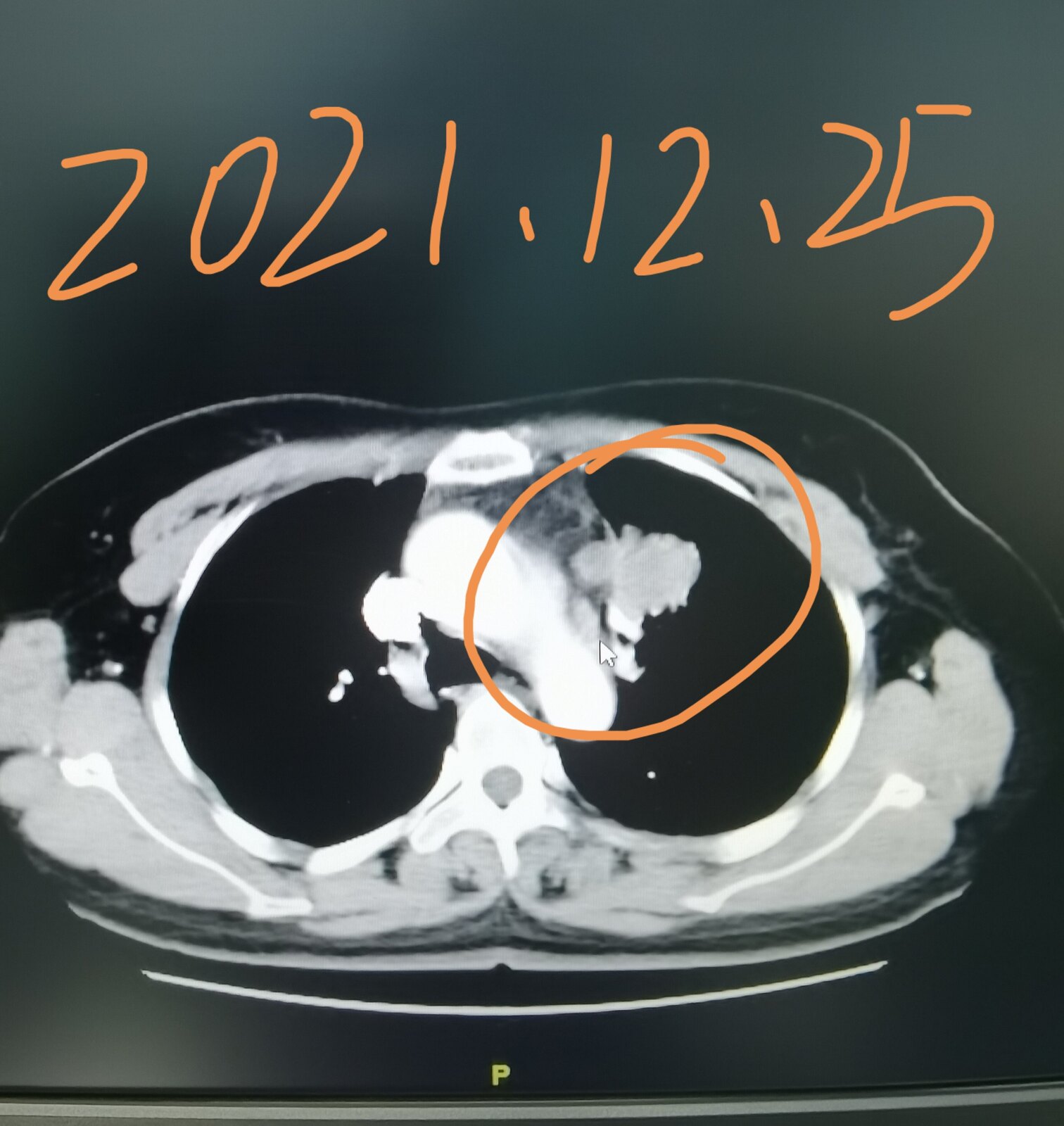 刘懿博士肺癌晚期症状,刘懿博士说肺癌微浸润复发