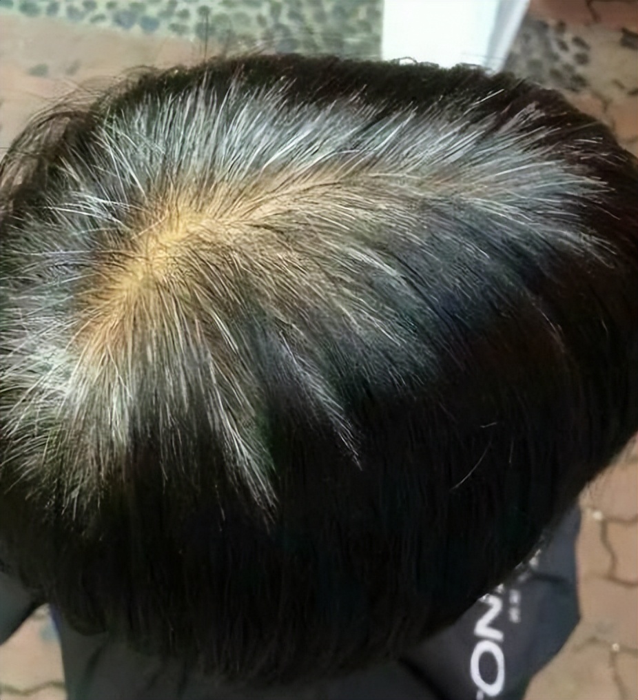 白头发越长越多缺什么营养,改善白头发生长有哪些营养素