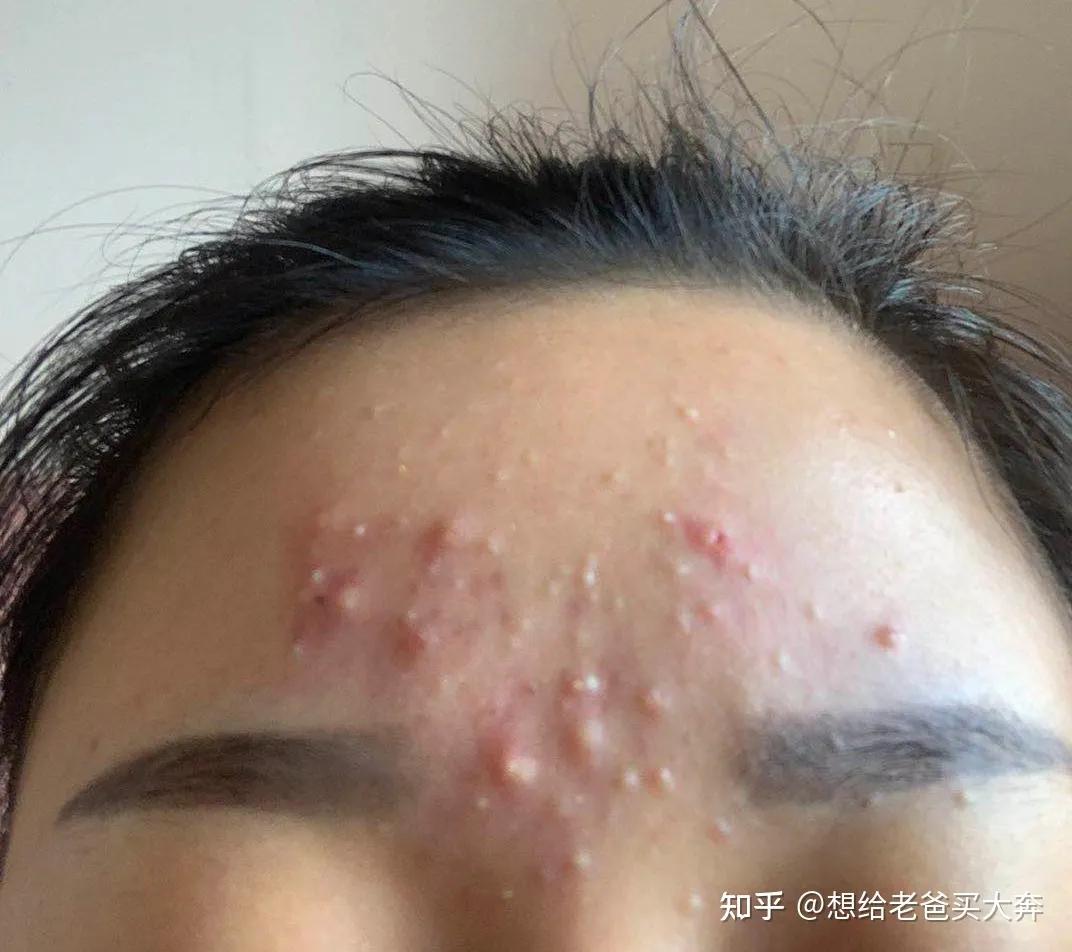 烂脸是怎么修复好的,满脸痘烂脸怎么治好