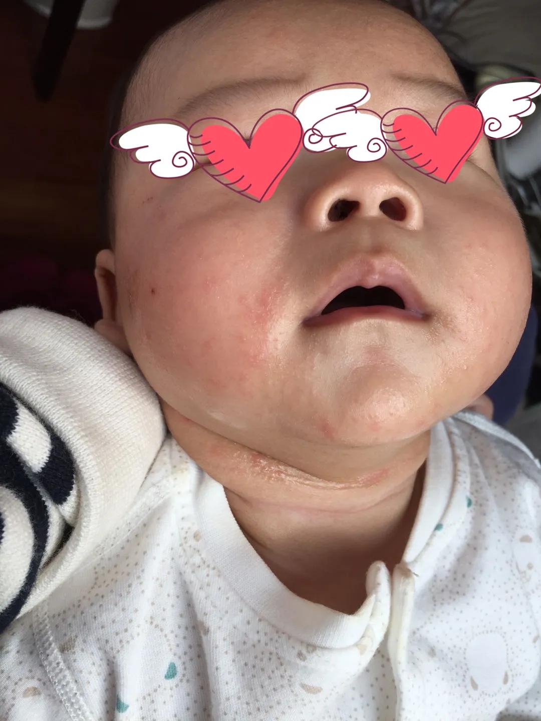 湿疹常年反复治不好怎么办,宝宝湿疹反复不好怎么回事