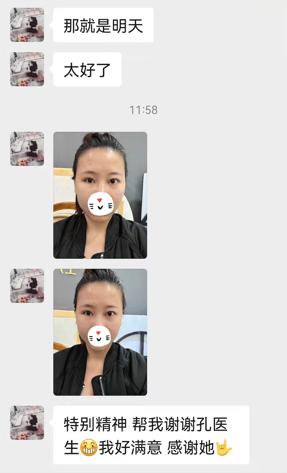 单眼上睑下垂恢复图,上眼睑下垂修复完大小眼明显