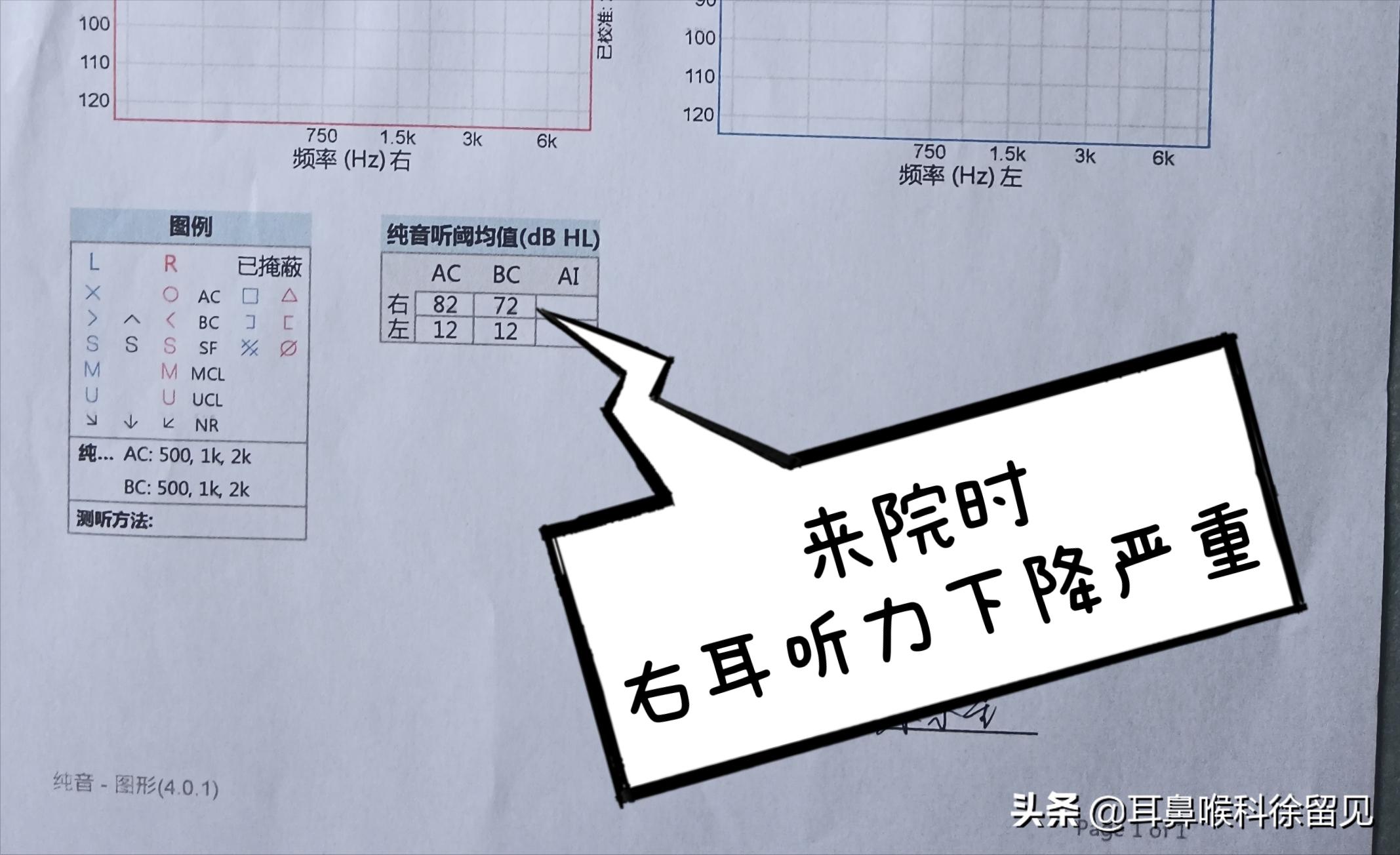 年轻女孩K歌后患上突发性耳聋,花了1周的时间做治疗