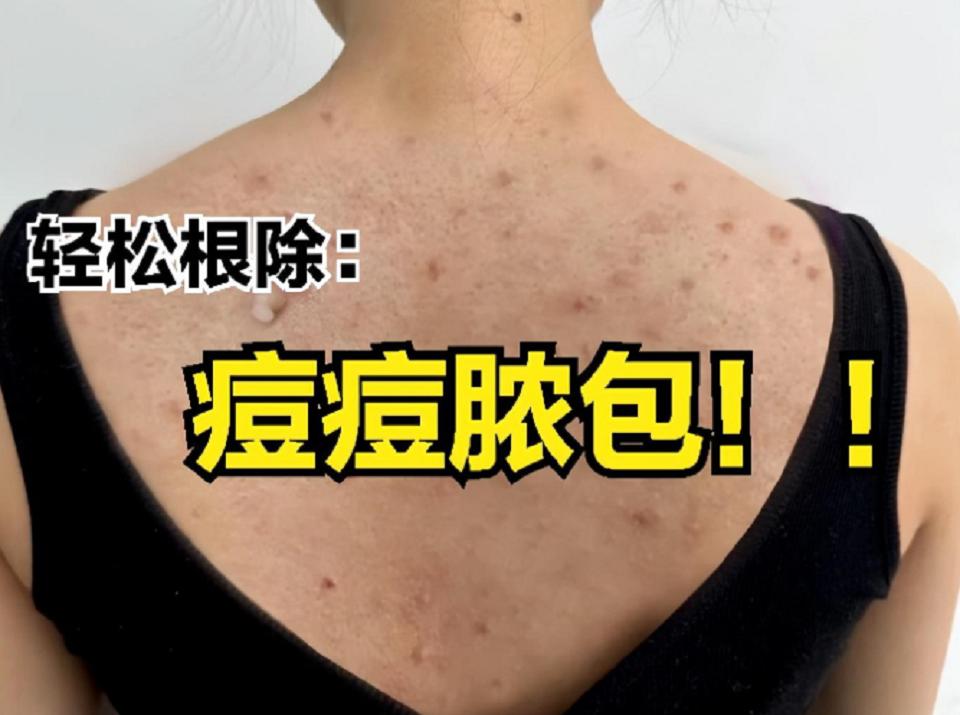 后背生疮是什么原因引起的,后背痤疮发痒怎么办