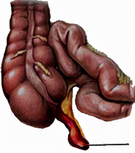 怀孕早期发现有阑尾炎怎么办,怀孕得阑尾炎怎么办胎儿能要吗
