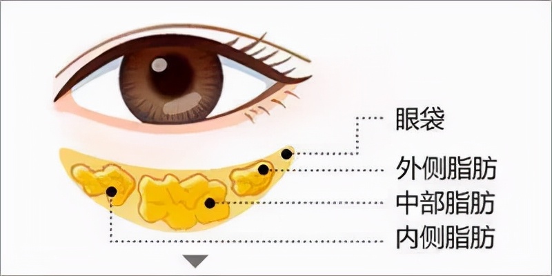 上海第九人民医院不开刀去除眼袋,顽固眼袋别担心不开刀也能变好看