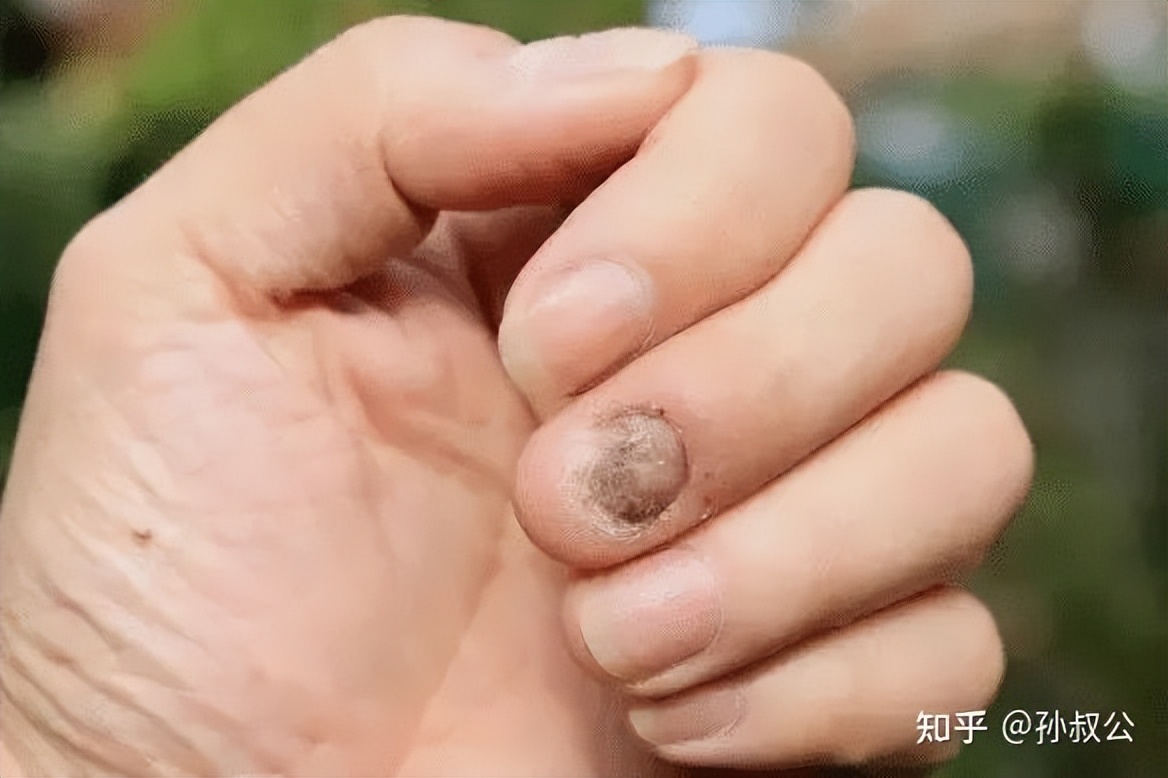 小孩得灰指甲怎么办,灰指甲往肉里长怎么办