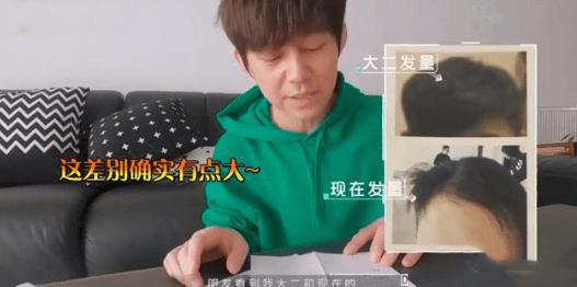 明星逃不过的脱发,明星也秃头还戴假发片