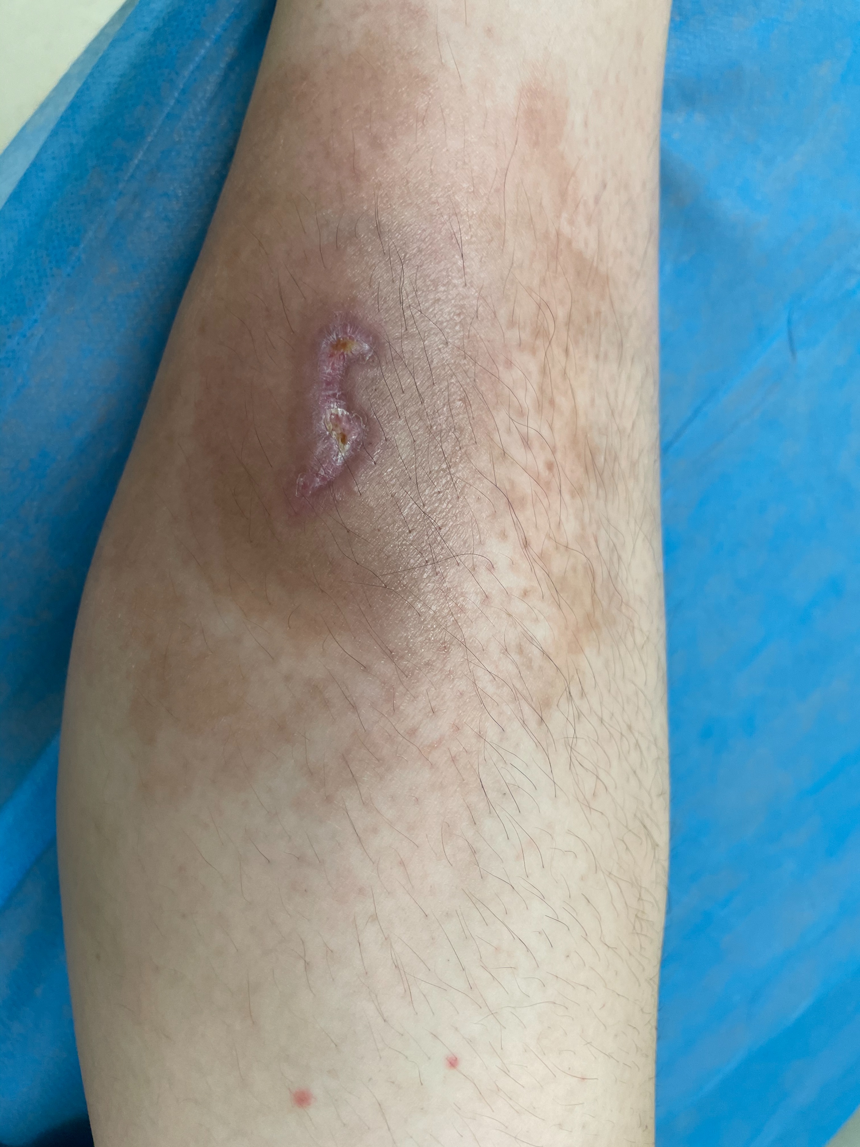 湿疹伤口腐烂怎么处理,创伤处湿疹