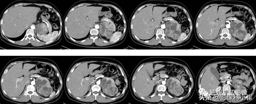 肾上腺疾病的诊断思路,肾上腺可能出现的病症有哪些