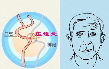 面肌痉挛下眼皮跳为什么会有凹陷,眼皮跳一个月就能确诊面肌痉挛吗