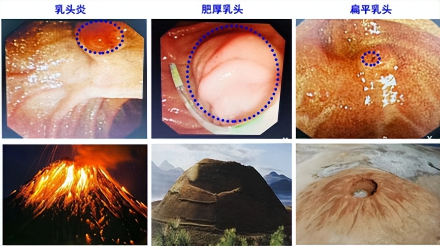 胆囊切除后腹胀怎么回事,胆囊切除术后腹胀怎么办