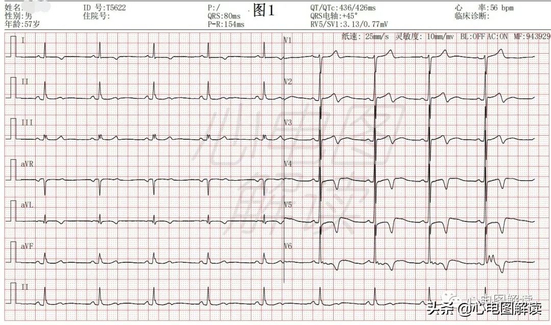 左室面高电压心电图诊断要点,左室高电压是正常吗