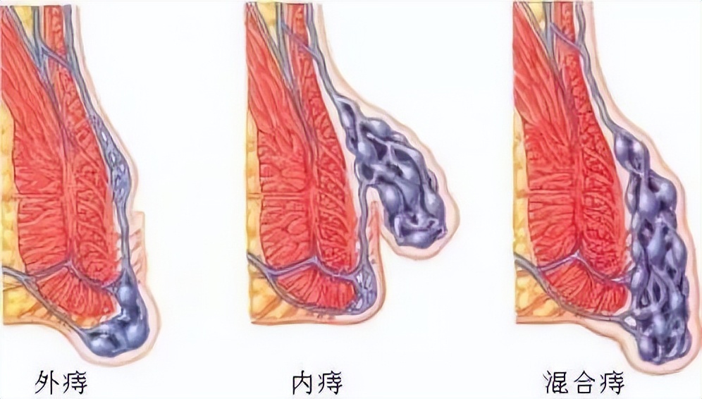 便血有没有可能是痔疮破了,便血是因为痔疮还是结肠有问题