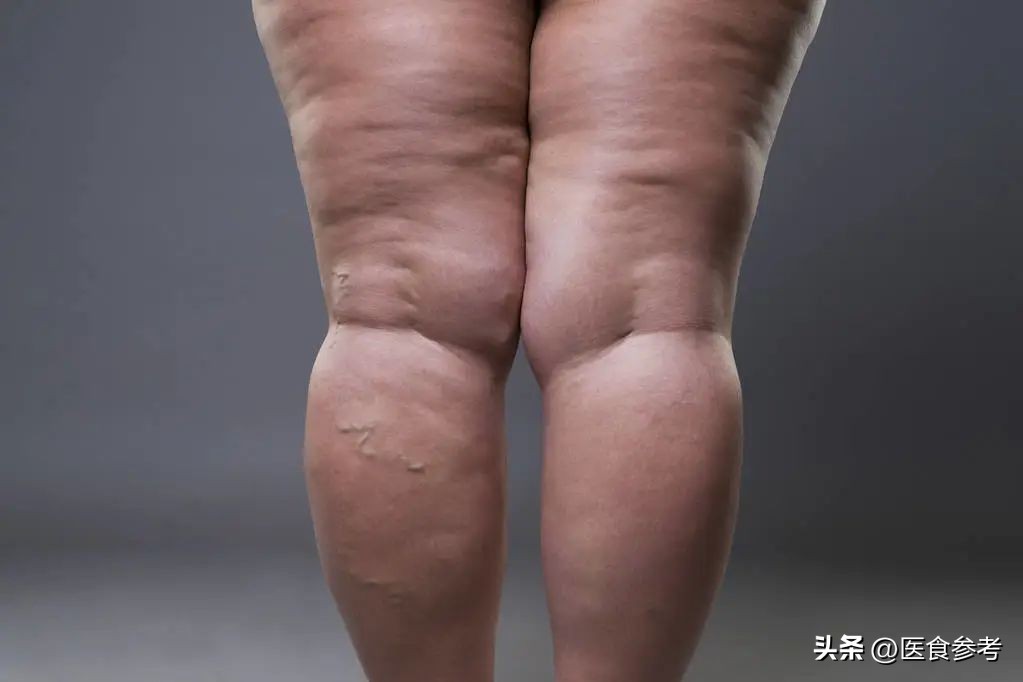 水肿吃什么食物消肿最快最好,水肿用什么药消肿效果最好