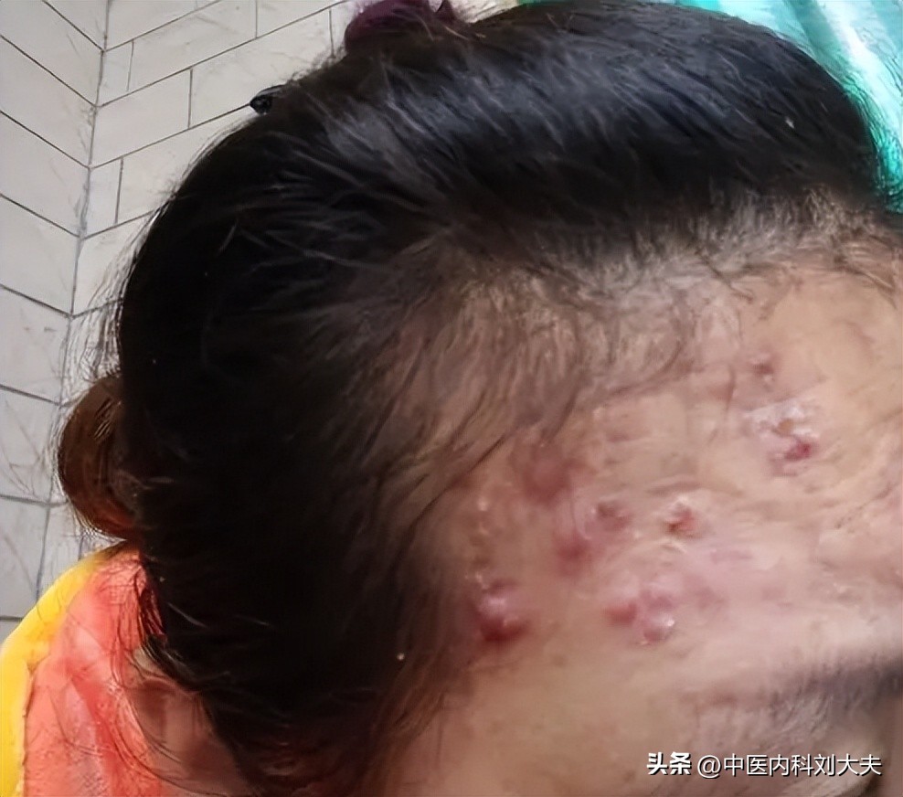 毛囊炎长痘痘你们怎么治好的,毛囊炎痘痘去除视频