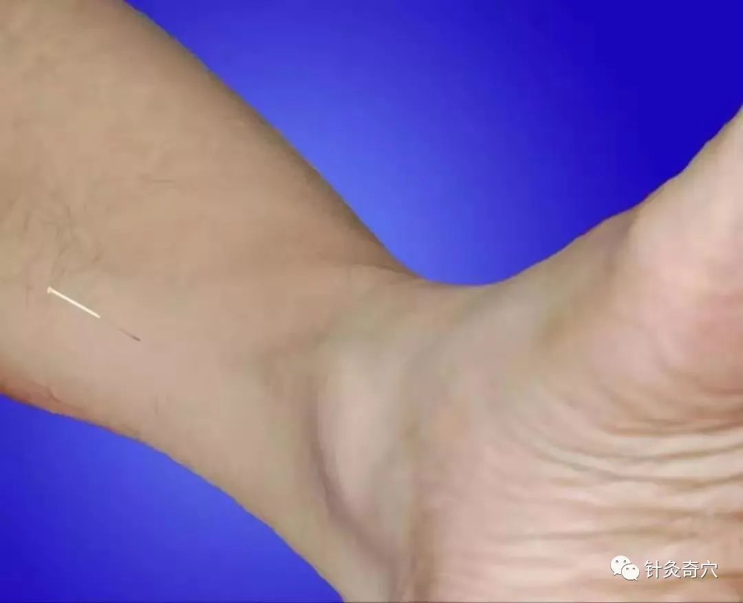 史上最全中医针灸视频教程全集,针灸治疗真实图片大全