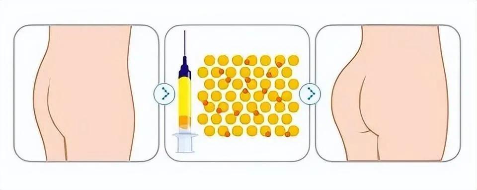 31岁女网红隆臀后高热不退，半边屁股红肿溃烂