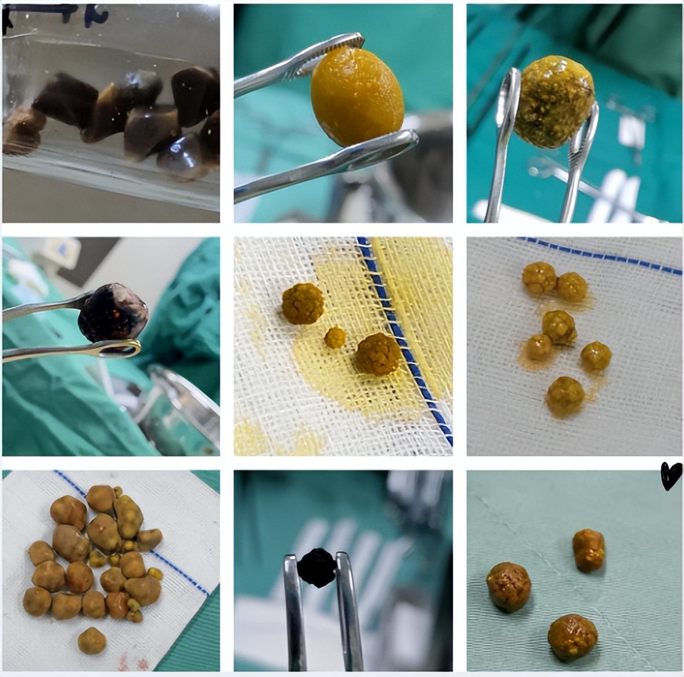 成都胆结石保胆取石,胆结石保胆哪里可以做成都