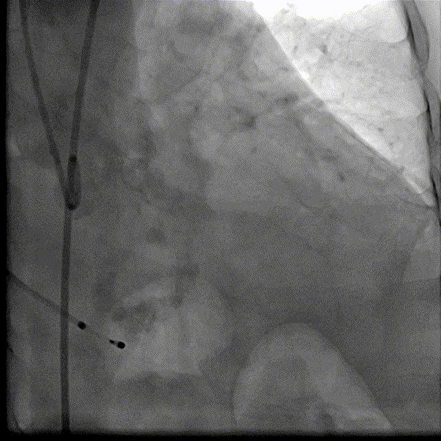 主动脉瓣狭窄病例讨论,25岁主动脉瓣狭窄用什么治疗方案