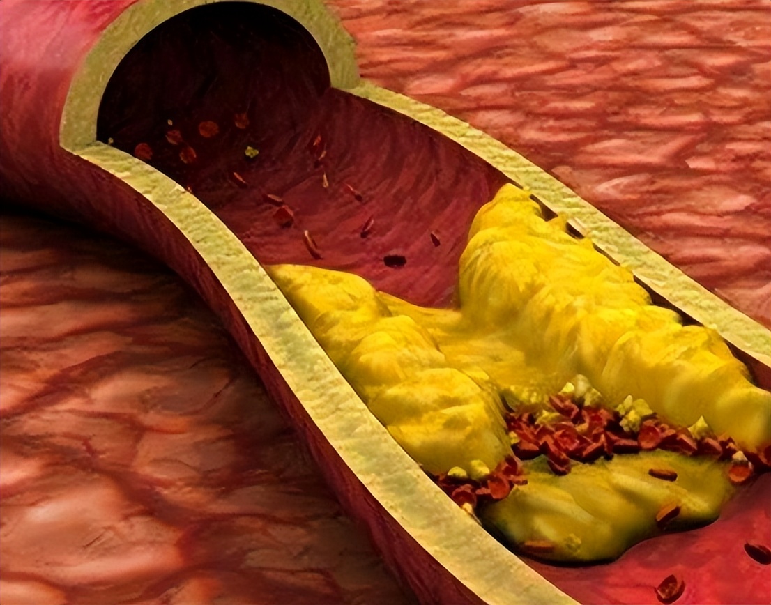 冠心病诊断预测模型,建模预测冠心病