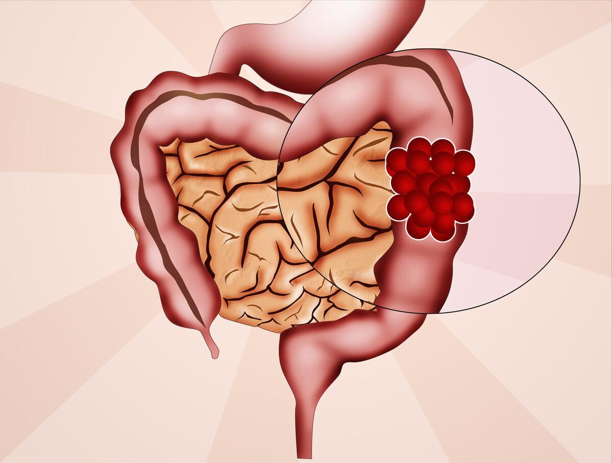 吃氯吡格雷便血怎么办,氢氯吡格雷片会导致便血吗