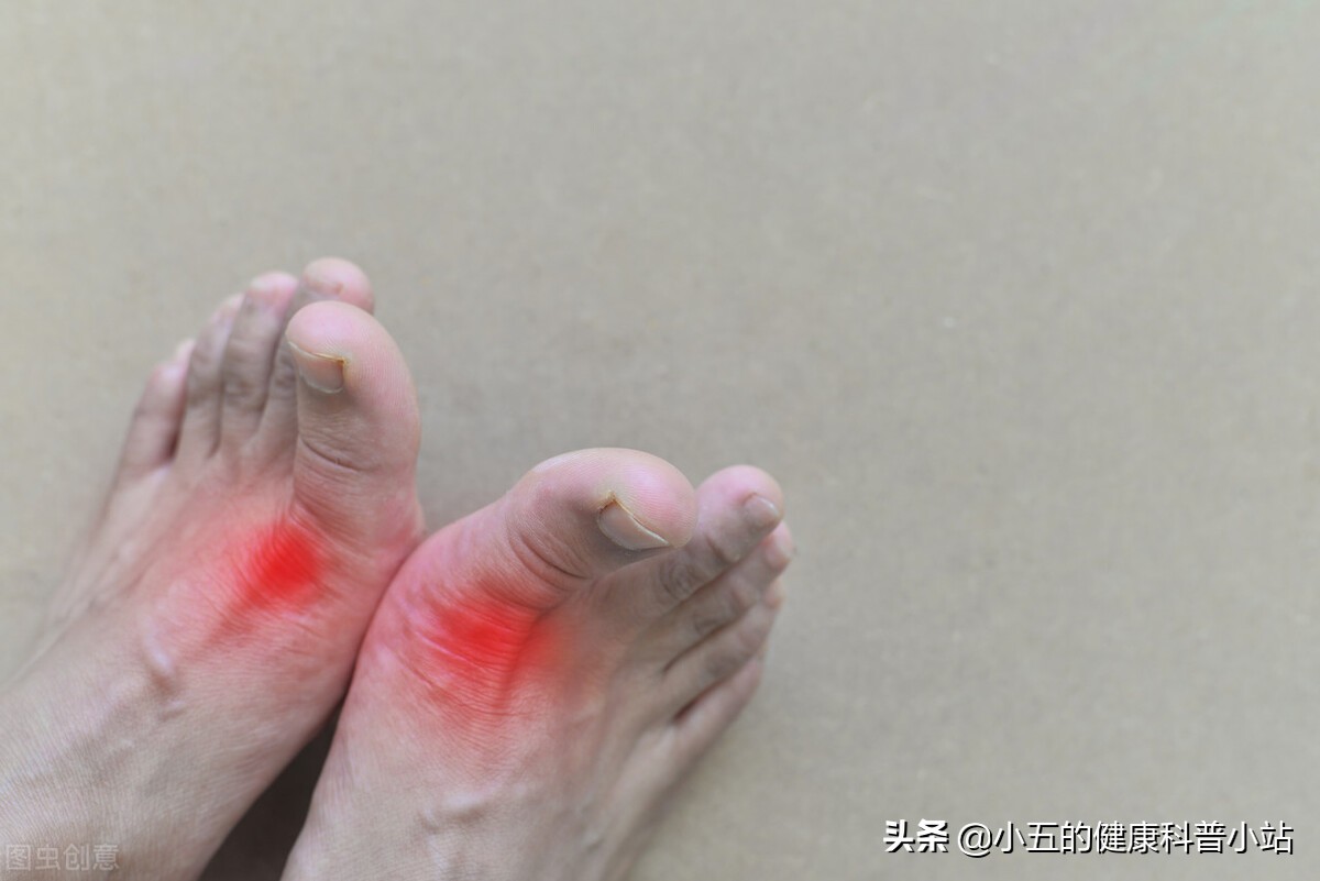 非布司他是防治痛风的常用药，可以长期服用，但需要注意这4点