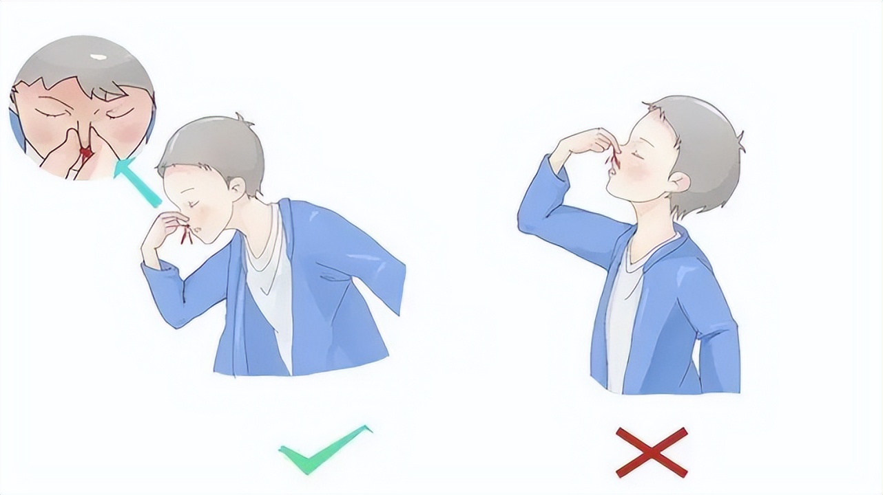 孩子流鼻血正确做法是？家长别再做“无用功”！