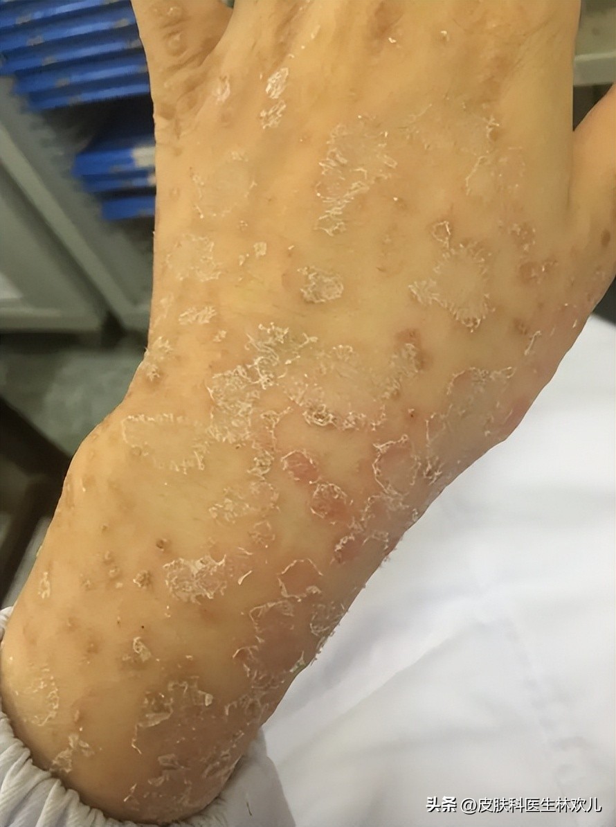 鼻翼两边泛红起皮抹芦荟胶有用吗,鼻翼两侧泛红起皮黄色结痂